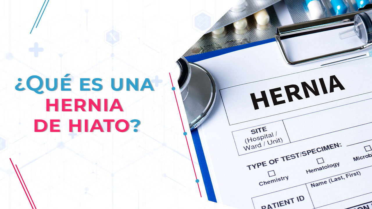 Imagen de ¿Qué es una hernia de hiato?