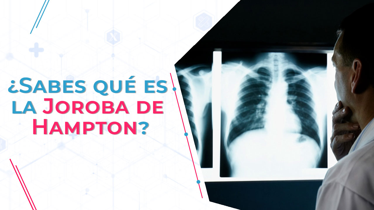Imagen de ¿Sabes qué es la Joroba de Hampton?
