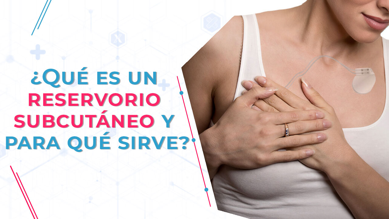 Imagen de ¿Qué es un reservorio subcutáneo y para qué sirve?