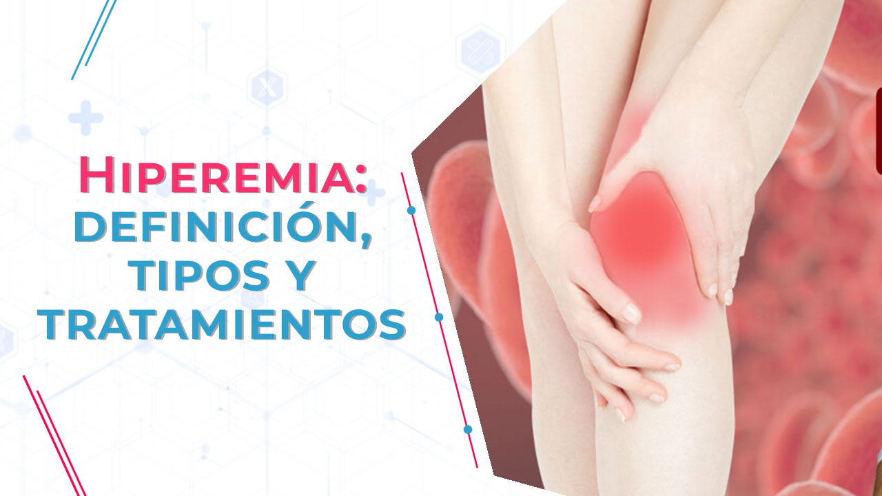 Imagen de Hiperemia: definición, tipos y tratamientos