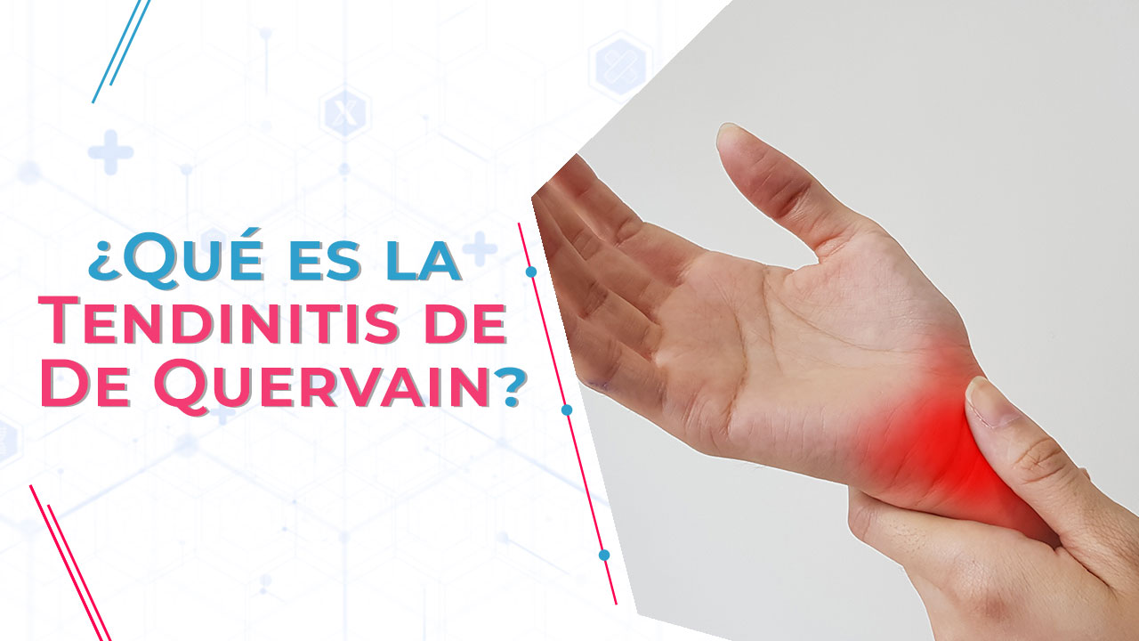 Imagen de ¿Qué es la Tendinitis de De Quervain?