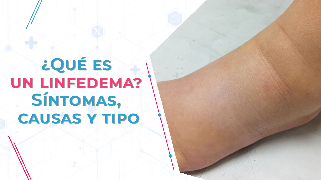 Imagen de ¿Qué es un linfedema? Síntomas, causas y tipos
