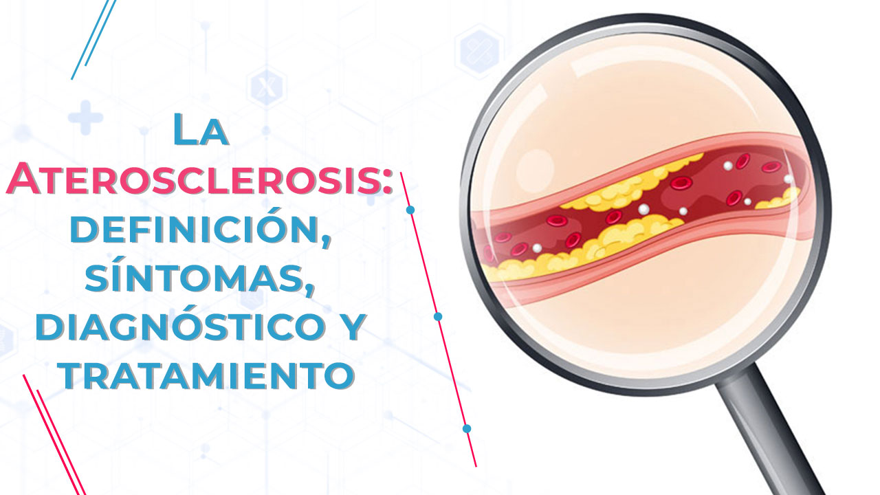 Imagen de La Aterosclerosis: definición, síntomas, diagnóstico y tratamiento