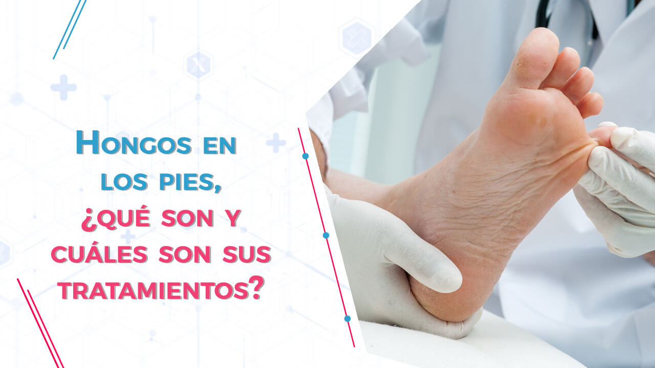 Imagen de Hongos en los pies, ¿qué son y cuáles son sus tratamientos?