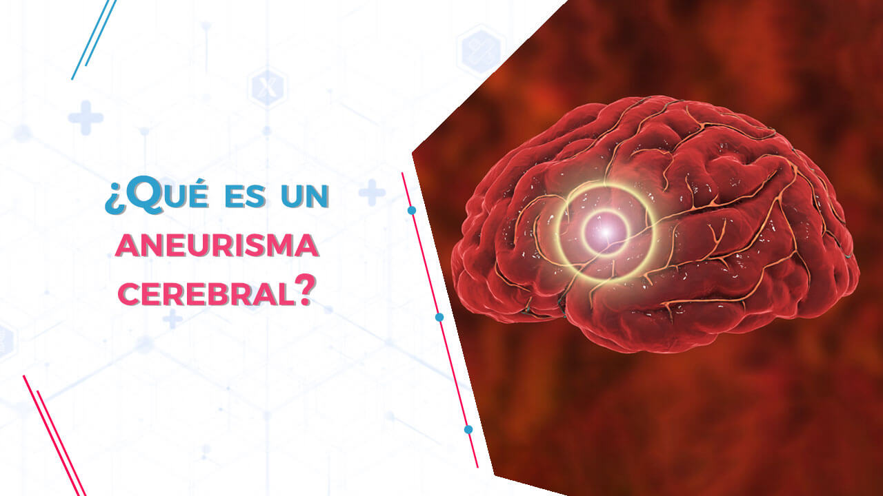 Imagen de ¿Qué es un aneurisma cerebral?