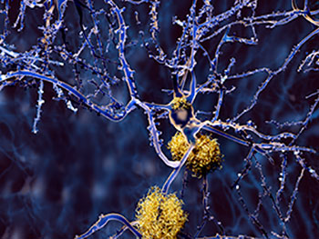 Alzheimer