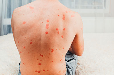 psoriasis espalda