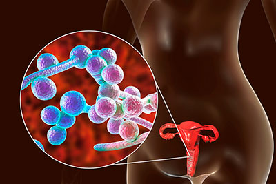 candidiasis