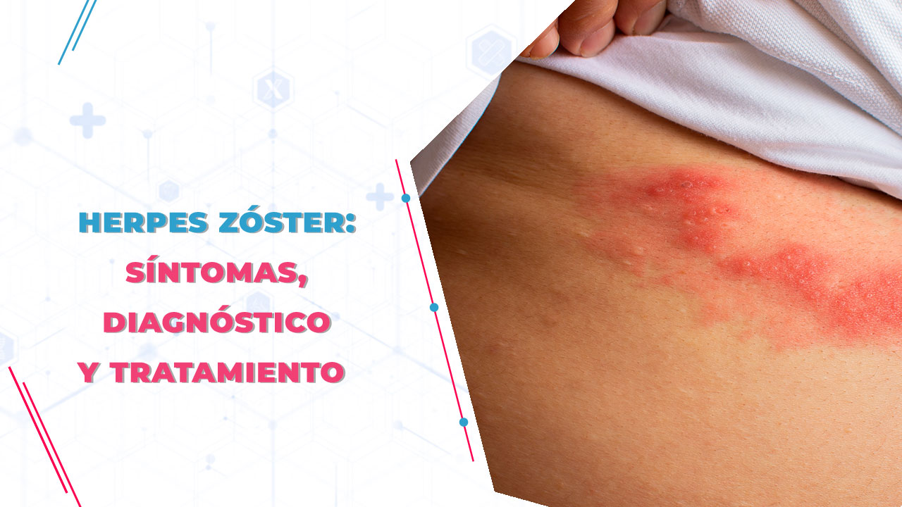 herpes zoster