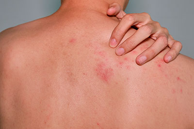 herpes