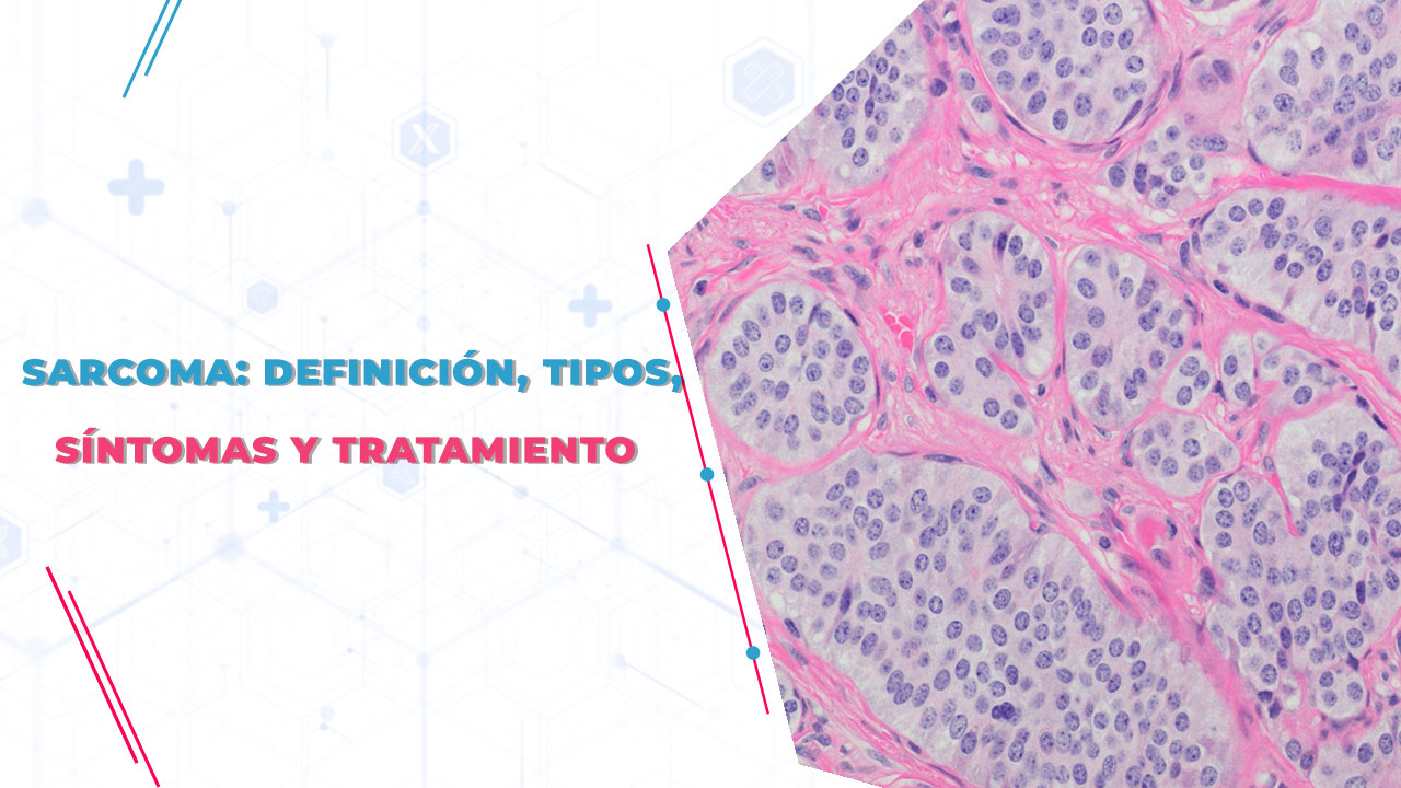 Imagen de Sarcoma: Definición, tipos, síntomas y tratamiento