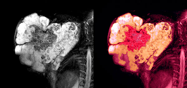 sarcoma