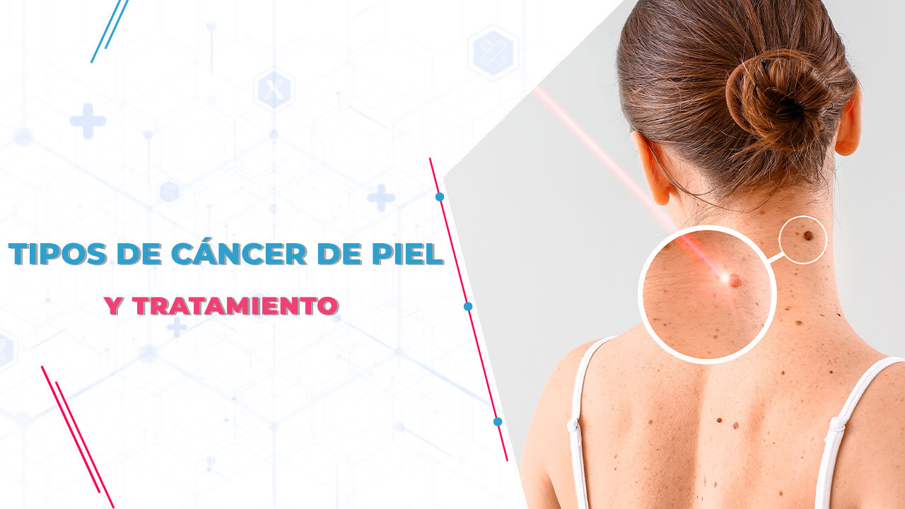 Imagen de Tipos de cáncer de piel y tratamiento